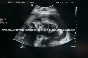 APAKAH JANIN YANG MENINGGAL DI PERUT IBUNYA HARUS AQIQAH?
